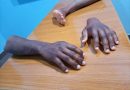 Meet The Man Who Makes Dark Skin Toned Prosthetics For Black Amputees